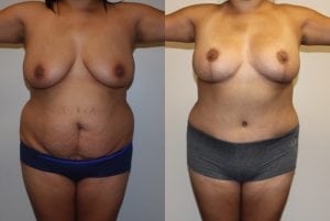 Before and After Image
