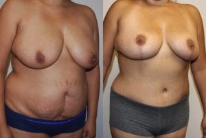 Before and After Image