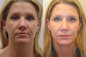 Before and After Image