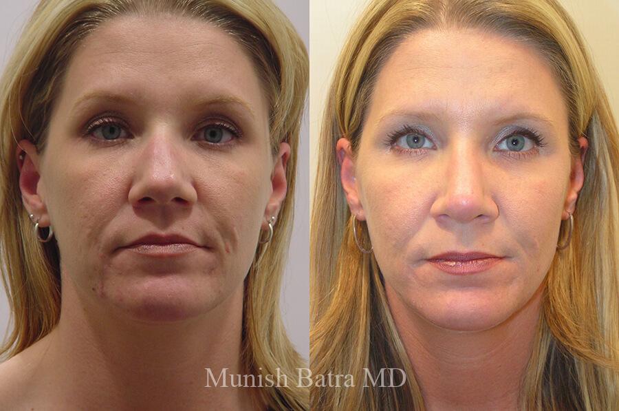 Before and After Image