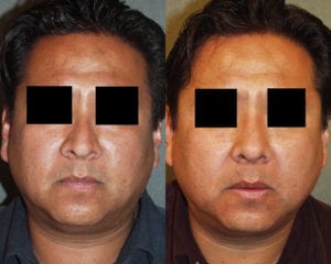 Before and After Image