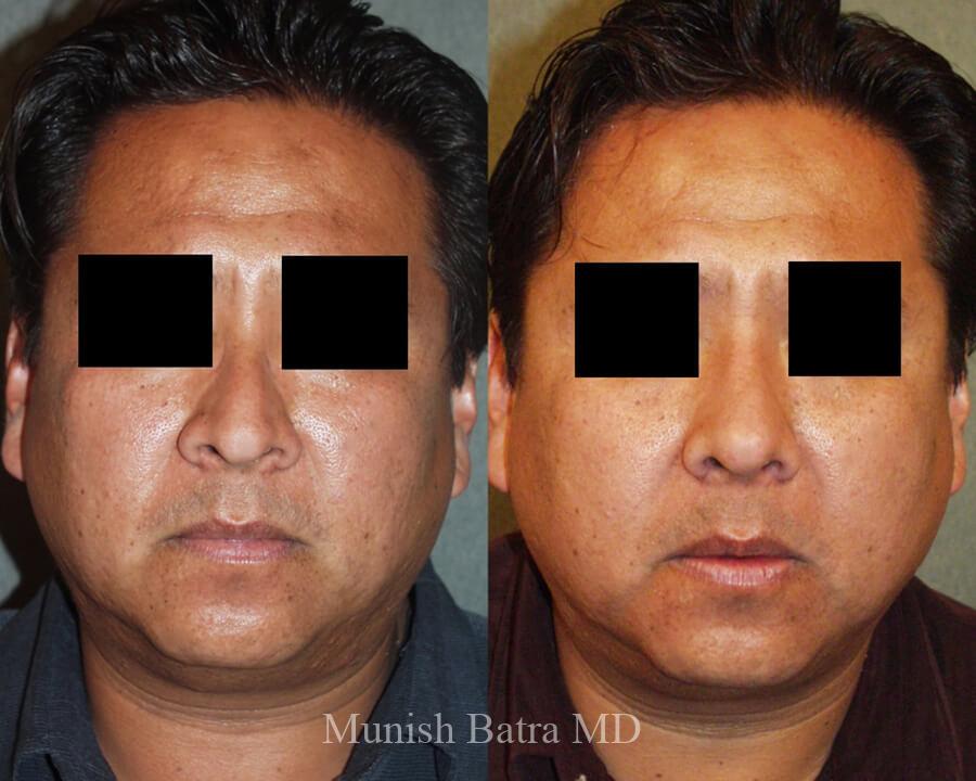Before and After Image
