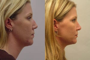 Before and After Image