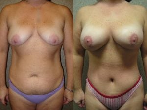 Before and After Image