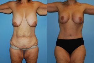 Before and After Image
