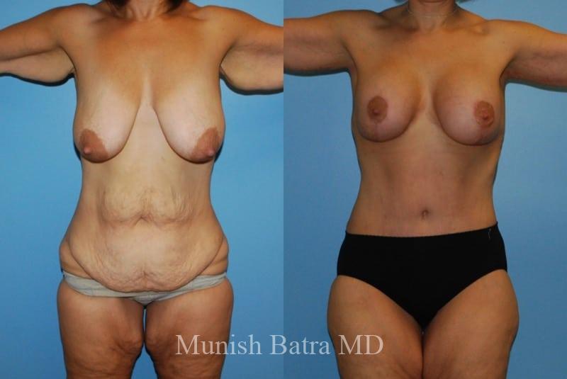 Before and After Image