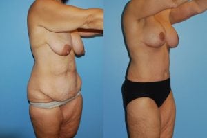 Before and After Image