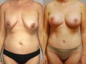 Before and After Image