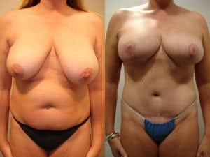 Before and After Image
