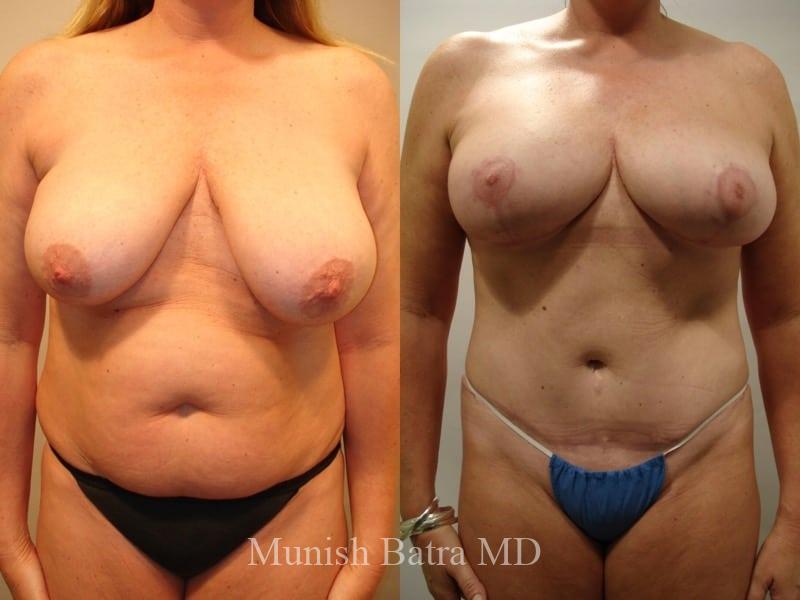 Before and After Image