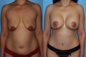 Before and After Image