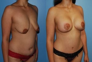 Before and After Image