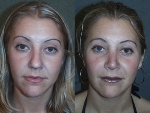 Before and After Image