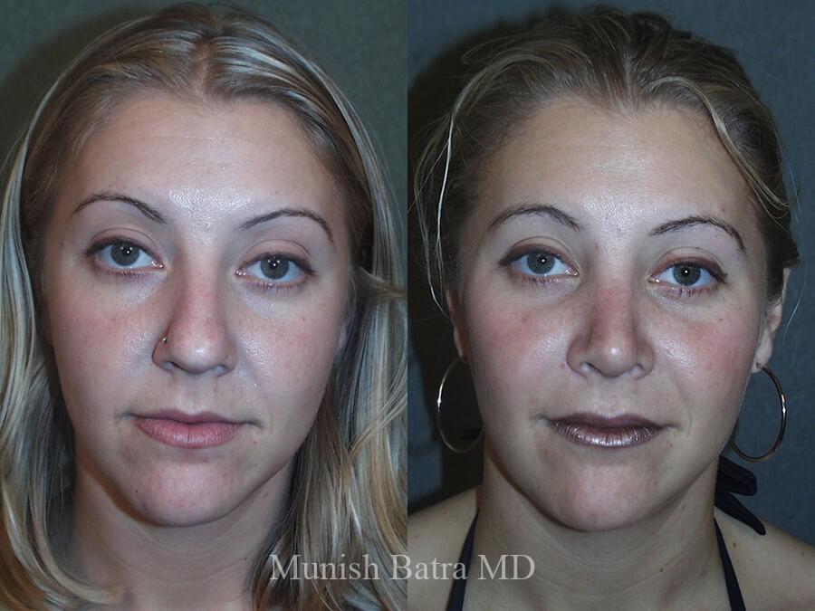 Before and After Image