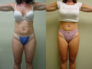 Before and After Image