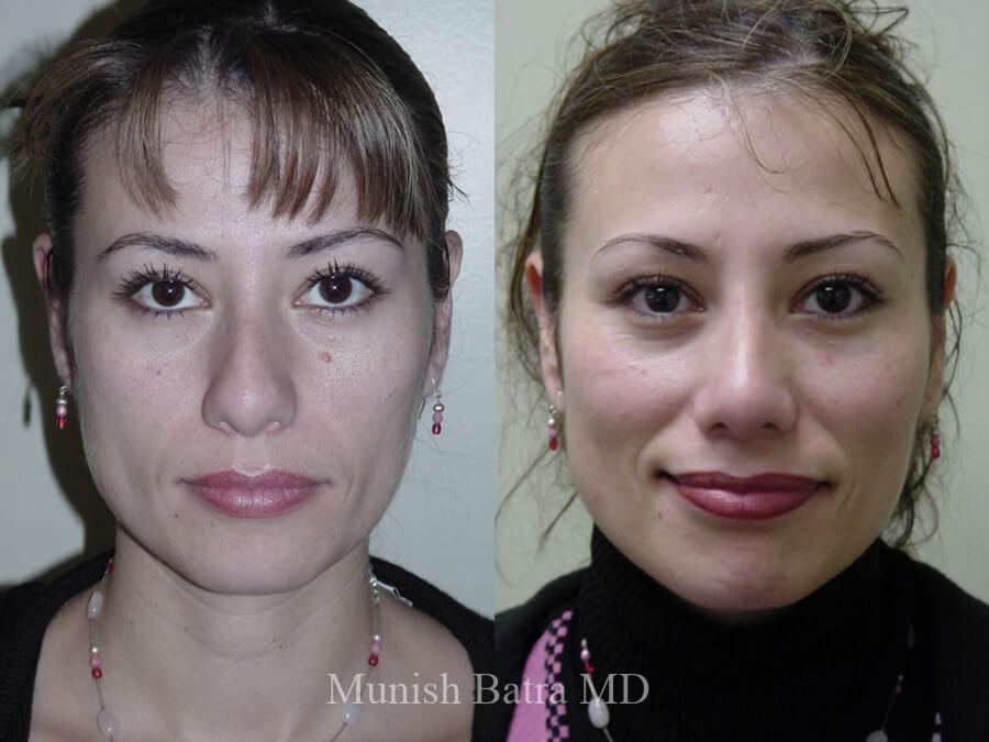Before and After Image