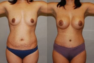 Before and After Image