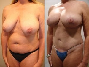 Before and After Image