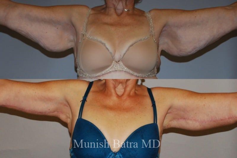 Before and After Image