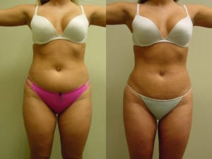 Before and After Image
