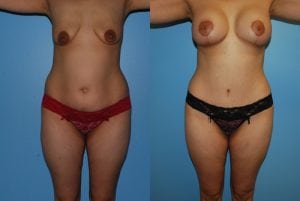 Before and After Image