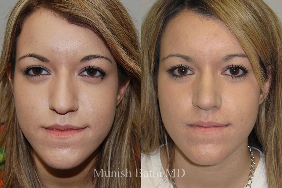 Before and After Image