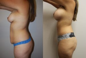 Before and After Image
