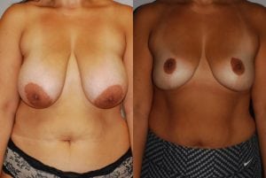 Before and After Image