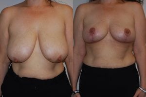 Before and After Image