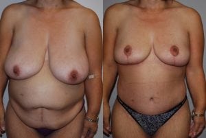 Before and After Image