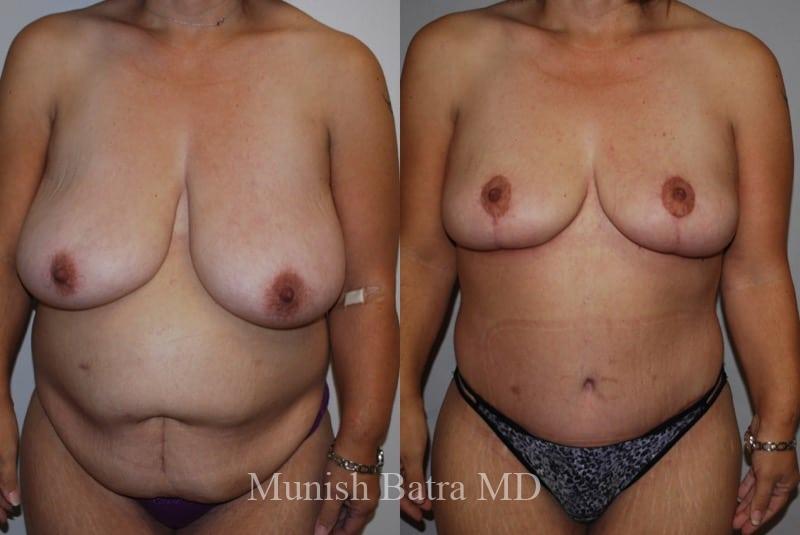 Before and After Image