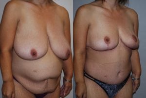 Before and After Image