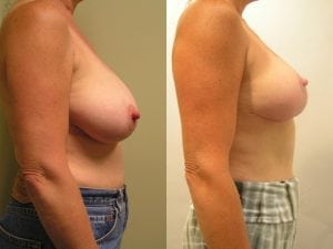 Before and After Image