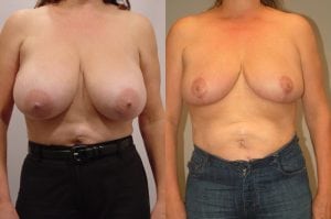 Before and After Image