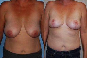 Before and After Image