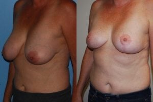 Before and After Image