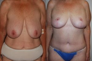 Before and After Image