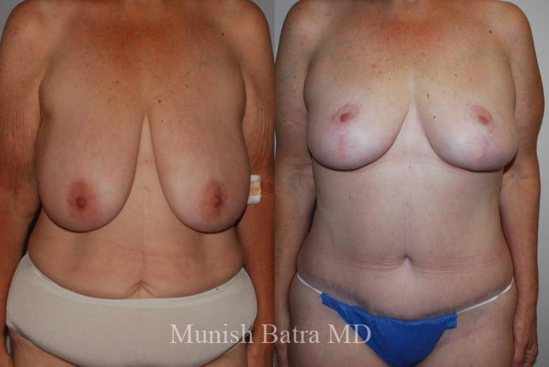Before and After Image
