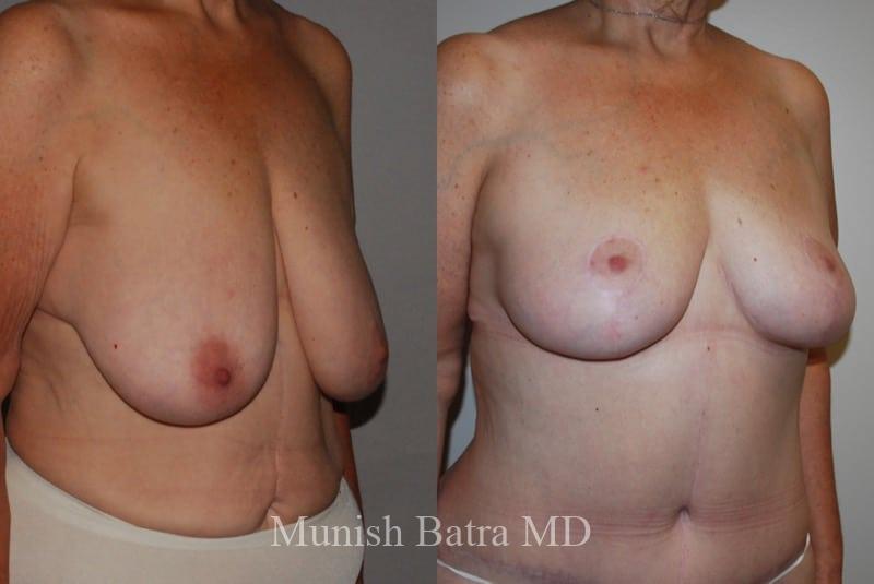 Before and After Image