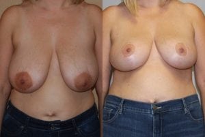 Before and After Image