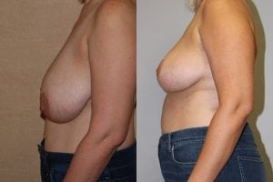 Before and After Image