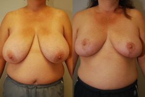 Before and After Image