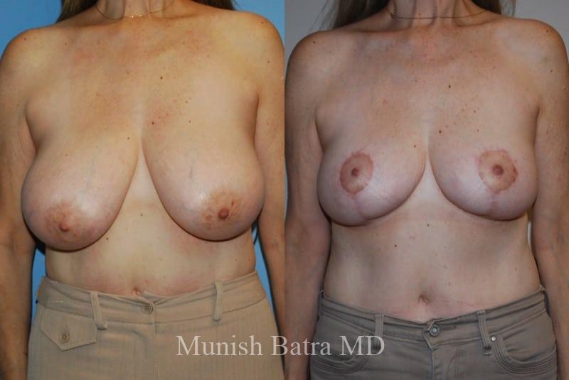 Before and After Image