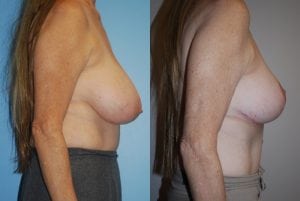 Before and After Image