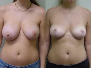 Before and After Image
