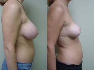 Before and After Image