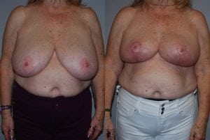 Before and After Image