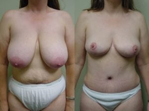 Before and After Image