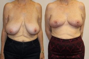 Before and After Image