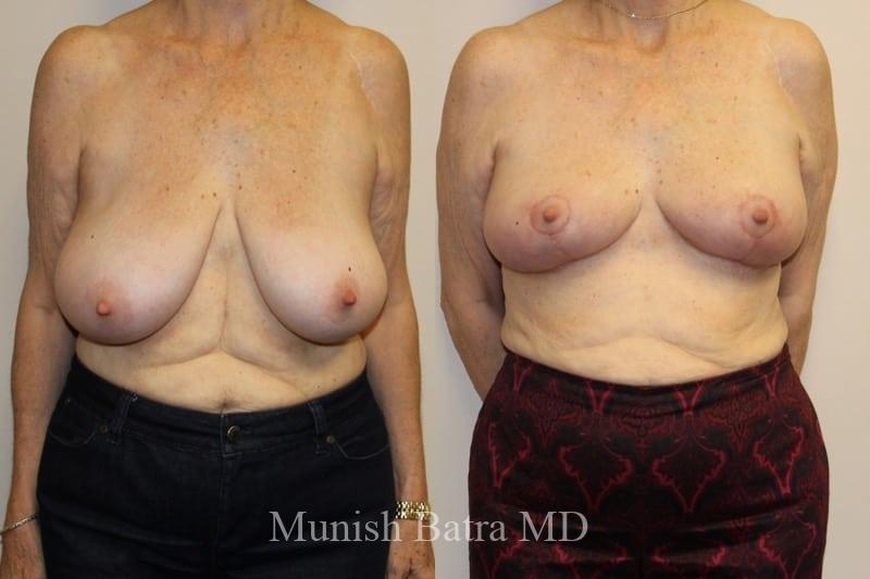 Before and After Image